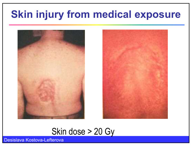 Two photographs of skin injury from medical exposure on the back, the first showing a circular area of skin damage and the second a red area of skin, with the caption that the skin dose exceeded 20 Gy