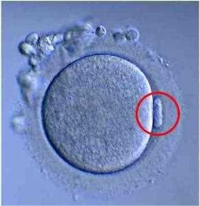 Human oocyte with the polar body circled in red, inside its zona pellucida and corona radiata