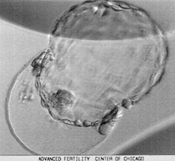 Blastocyst photographed in an IVF laboratory, a hollow ball with a cell clump inside the zona pellucida
