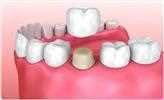 Fixed bridge: a pontic filling a gap between two prepared teeth, with a crown on each abutment