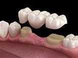 Fixed bridge over a row of teeth: crowns joined as one unit, with the pontic filling the gap