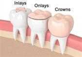 Two inlays, onlays and crowns, shown on a row of teeth from left to right: an inlay, an onlay and a full crown