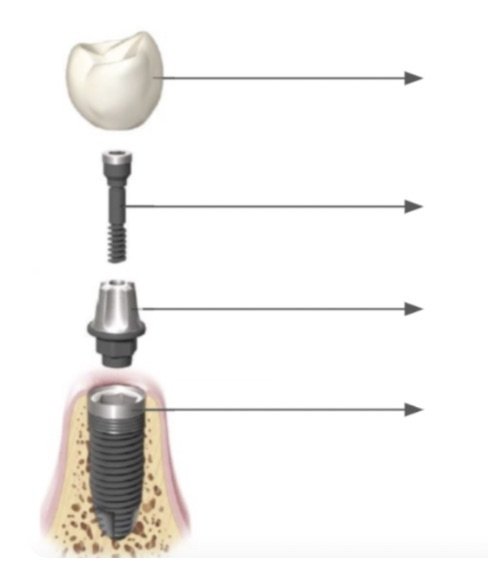 Exploded view of an implant restoration from top to bottom: crown, abutment screw, abutment and implant fixture placed in the jaw, each with an arrow for labelling