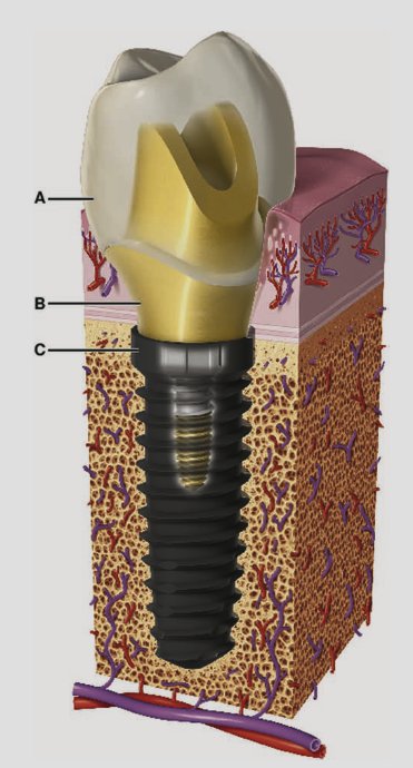 Single implant restoration in bone, cross-section with the crown, a gold-coloured abutment and the implant fixture in the jaw, labelled A, B and C