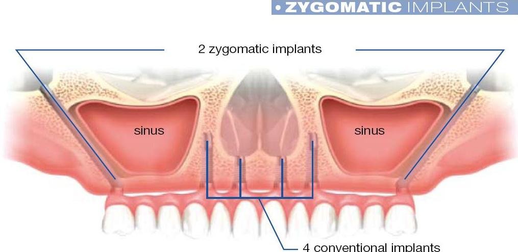 Maxilla with two zygomatic implants running from the lateral maxilla through each maxillary sinus, compared with four conventional implants placed in the anterior maxilla