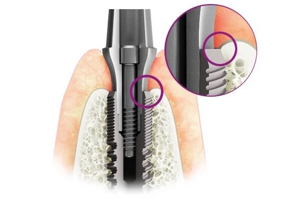 Implant with abutment seated in the jaw, with a circled magnified inset of the implant neck at crestal bone level showing the threads and surrounding bone