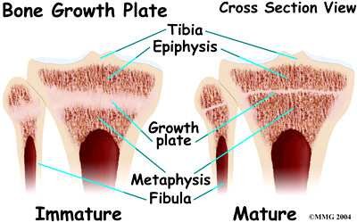 Cross-section through an immature and a mature epiphysis of the tibia and fibula, comparing the thick growth plate of the immature bone with the thin, closed growth plate of the mature bone