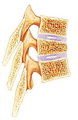 Three lumbar vertebrae in longitudinal section, showing the spongy bone of the vertebral bodies and the intervertebral discs between them