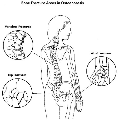 Typical sites of osteoporotic fracture: vertebral (compression) fractures of the spine, hip fractures, and wrist fractures