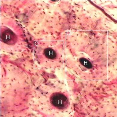 Ground section of compact bone under the microscope, with several Haversian canals (marked H) each surrounded by concentric lamellae and osteocyte lacunae
