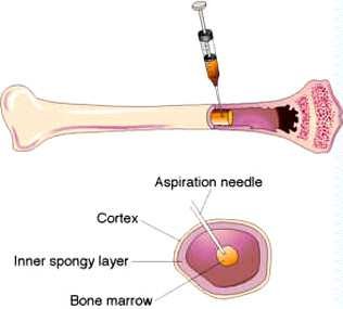 Diagram of a bone marrow aspiration needle passing through the cortex and inner spongy layer of bone into the bone marrow