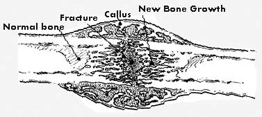 Fracture of a long bone shaft, showing the callus bridging the fracture and new bone growth extending from it, compared with normal bone