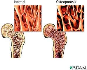 Comparison of normal and osteoporotic bone at the femoral head: the osteoporotic bone shows markedly thinned, sparser trabeculae