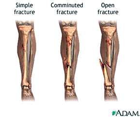Three types of fracture of the tibia and fibula: a simple fracture, a comminuted fracture, and an open fracture with a break in the overlying skin