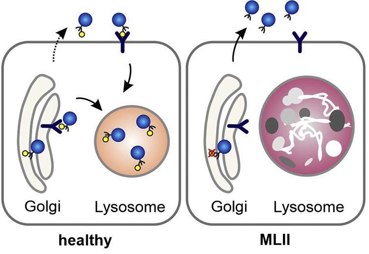 Healthy versus MLII cell: in the healthy cell phosphorylated lysosomal enzymes are captured by M6P receptors from the Golgi into the lysosome, in the MLII cell the enzyme cannot be phosphorylated, is not captured, and is secreted instead