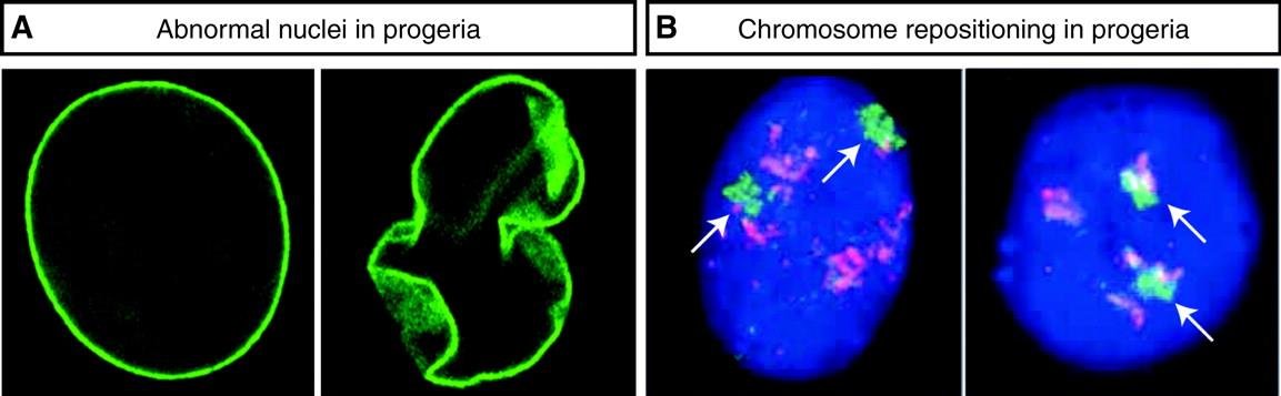 Progeria: abnormal, folded nuclear shape (green nuclear lamina) compared with a normal round nucleus, and repositioned chromosome territories, arrowed, in progeria nuclei
