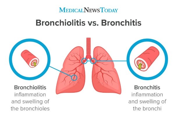 Diagram comparing bronchiolitis with bronchitis: a lung drawing with two magnified airway cross-sections, one labelled bronchiolitis, inflammation and swelling of the bronchioles in the lower lung, and one labelled bronchitis, inflammation and swelling of the bronchi near the centre of the lung