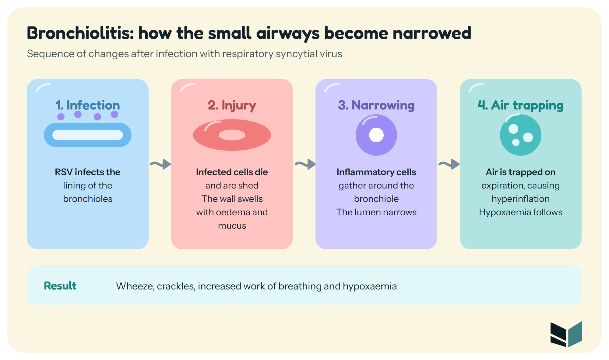 Four-step sequence of bronchiolitis: 1 Infection, RSV infects the lining of the bronchioles; 2 Injury, infected cells die and are shed and the wall swells with oedema and mucus; 3 Narrowing, inflammatory cells gather around the bronchiole and the lumen narrows; 4 Air trapping, air is trapped on expiration causing hyperinflation, with wheeze, crackles and hypoxaemia as the result